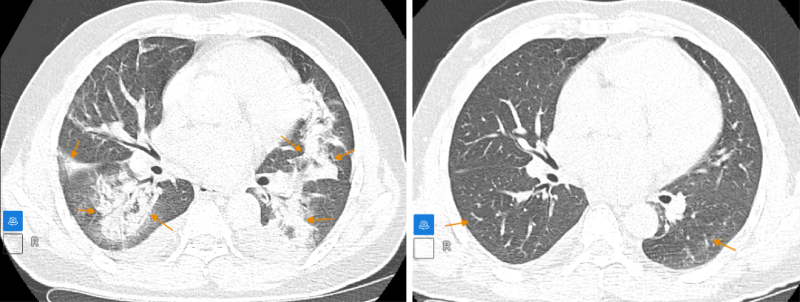 Bệnh nhân đáp ứng tốt phác đồ điều trị, tổn thương được giảm đáng kể (Ảnh trái: Trước điều trị - Ảnh phải: Sau điều trị) 