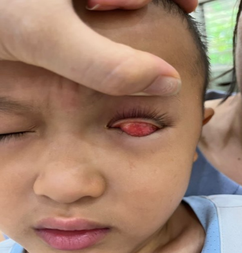 Bờ mi hai mắt của bé trai có triệu chứng đỏ, nề nhẹ 