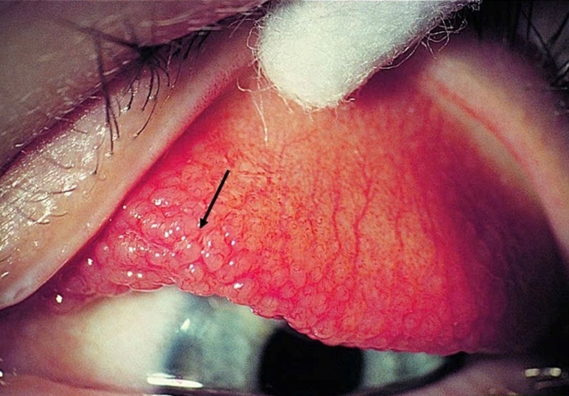 Kết mạc của bệnh nhi xung huyết rõ, xuất hiện nhiều nhú dạng đá lát ở kết mạc mi 