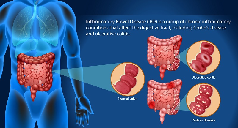 Rối loạn miễn dịch dễ gây nên bệnh Crohn 