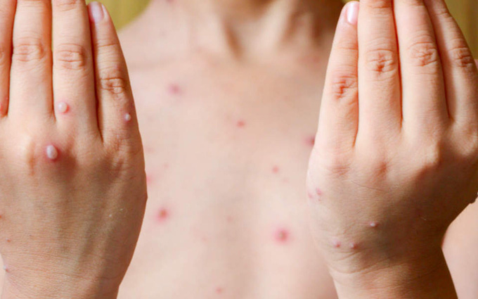 Mụn thủy đậu chứa dịch trong, rất dễ vỡ và có nguy cơ nhiễm trùng nếu gãi