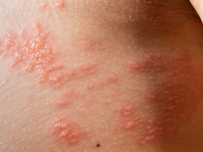 Phân biệt mụn thủy đậu với zona thần kinh dựa vào vị trí và tính chất tổn thương