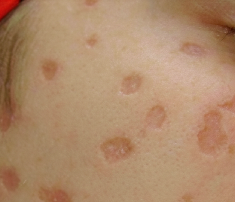 Khi bị nhiễm trùng, mụn thủy đậu có thể để lại sẹo lõm vĩnh viễn trên da