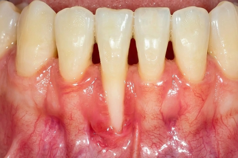 Khi tụt lợi xảy ra, răng thường có cảm giác “dài ra” hơn so với trước.