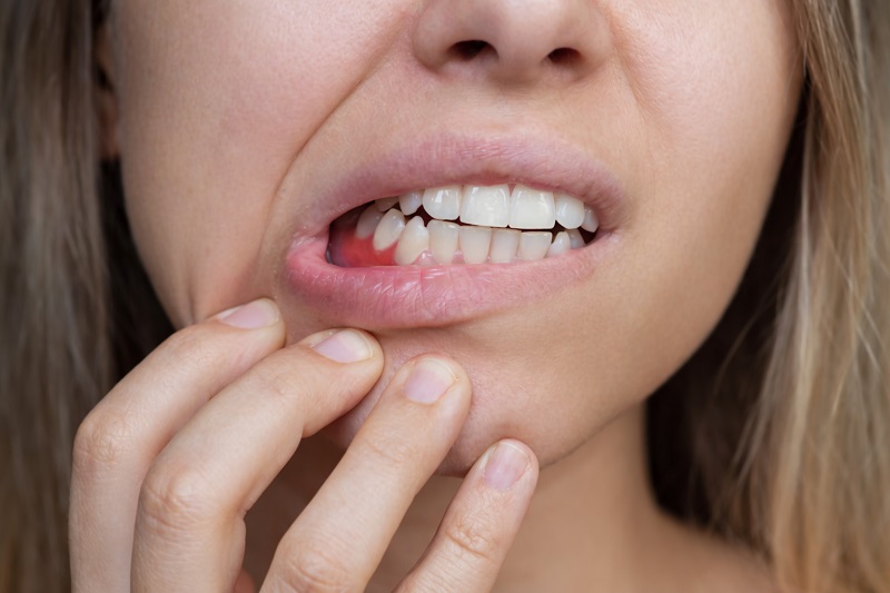 Tụt lợi do viêm nha chu là nguyên nhân thường gặp.