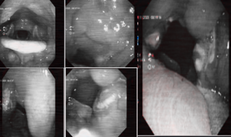 Kết quả nội soi tai mũi họng của bệnh nhân  