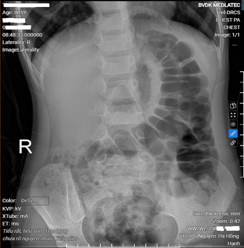 Hình ảnh chụp X-quang ổ bụng của bệnh nhi thấy nhiều quai đại tràng giãn, chứa hơi và phân 