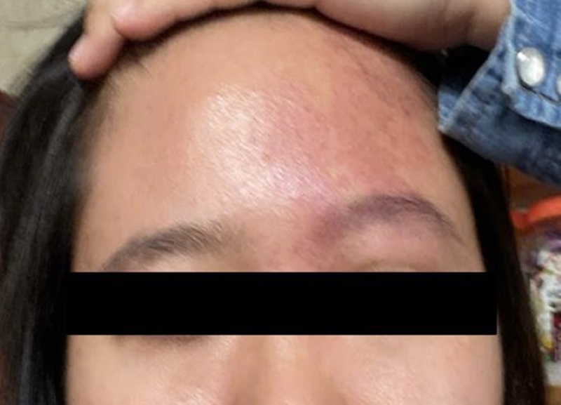 Bệnh nhân có vết bớt rượu vang vùng trán cung mày phải  