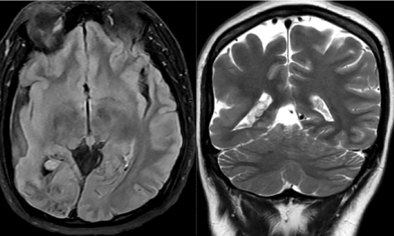 Bất thường được phát hiện trên phim chụp MRI sọ não  