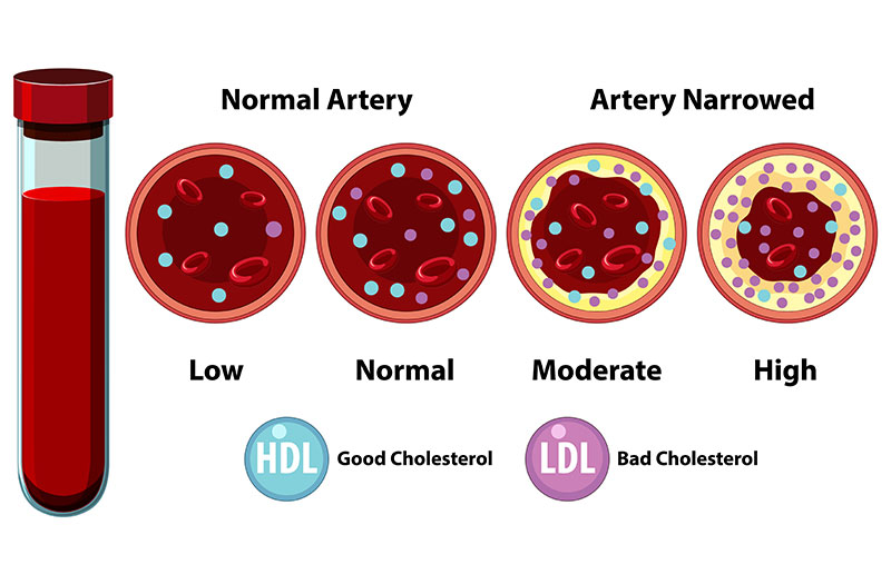 Rối loạn chuyển hóa lipid máu xảy ra khi lượng mỡ máu thay đổi bất thường