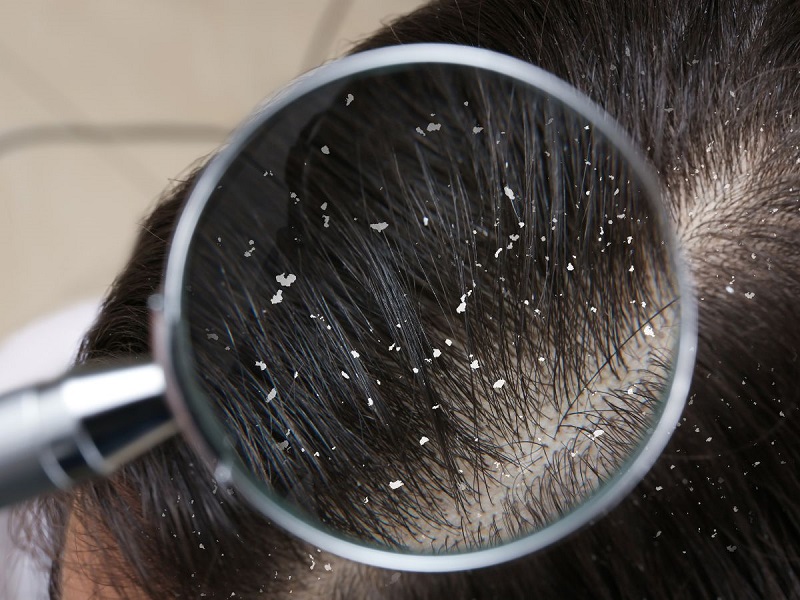 Người dân nhiều nơi dùng quả trấp để làm sạch tóc, giảm gàu