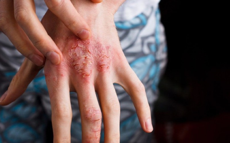 Người dân nên thực hiện xét nghiệm giun sán nếu xuất hiện các triệu chứng nghi ngờ