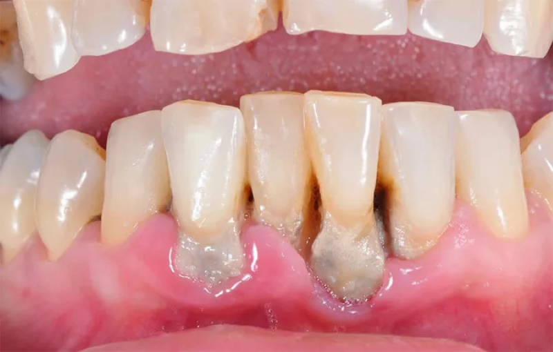 Vệ sinh răng miệng không đảm bảo là một trong những nguyên nhân dẫn đến tình trạng viêm nha chu