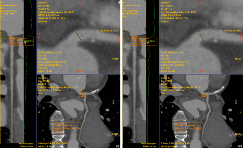 Bất thường được phát hiện trên phim chụp MSCT mạch vành của bệnh nhân