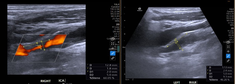 Hình ảnh siêu âm động mạch cảnh của bệnh nhân phát hiện nhiều vị trí hẹp