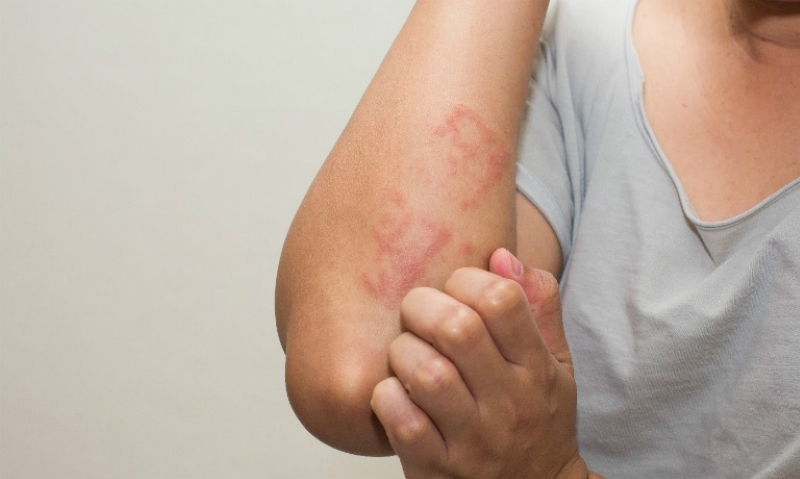 Sán chó là một trong những bệnh lý gây nguy hiểm cho sức khỏe con người