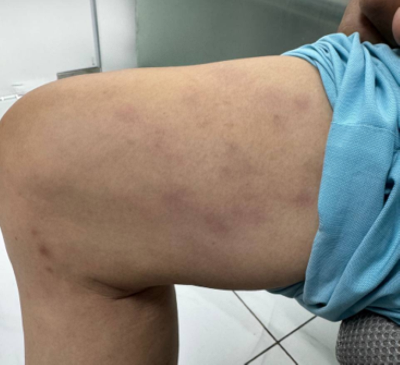 Bệnh nhân được chẩn đoán xác định lupus do thuốc liên quan đến Lisinopril