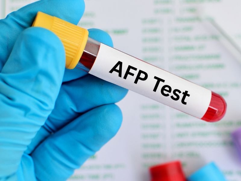 Bạn đọc cần nắm rõ chỉ số AFP trong máu bao nhiêu là bình thường để chủ động bảo vệ sức khỏe