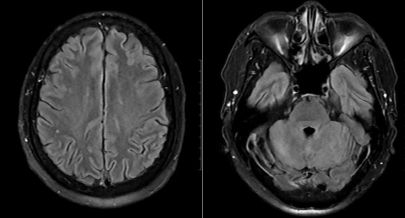Tổn thương phát hiện trên phim chụp MRI của bệnh nhân  