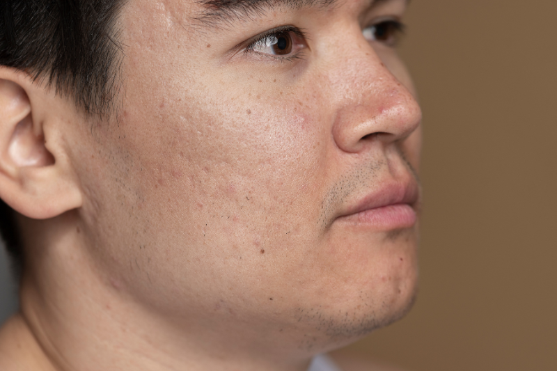 Tế bào gốc làm giảm sưng mụn nhanh, hạn chế sẹo rỗ và mụn lây lan