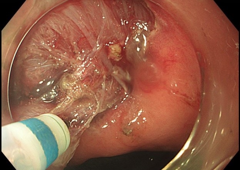 Khối u được can thiệp qua nội soi dạ dày bằng kỹ thuật ESSD