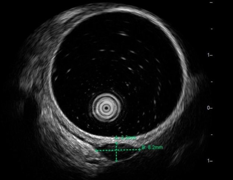 Khối u được phát hiện trên hình ảnh siêu âm nội soi