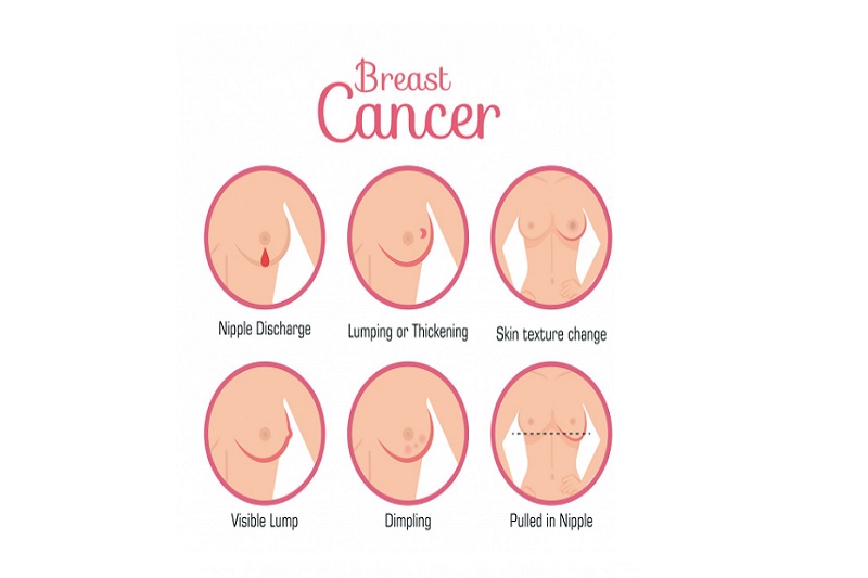 Hình ảnh mô phỏng dấu hiệu gặp phải ở bệnh ung thư vú di căn hạch nách