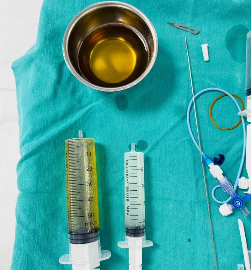 Lượng dịch hút ra từ nang thận lên tới 120ml