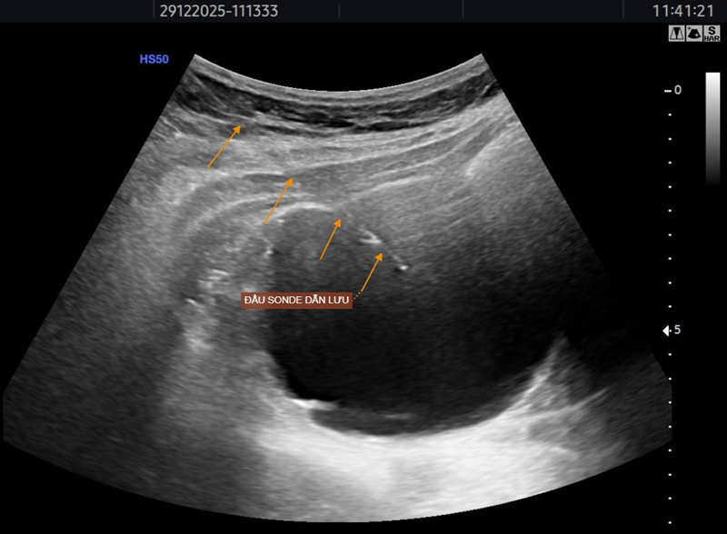Hình ảnh hút dịch nang thận bằng sonde dẫn lưu dưới hướng dẫn siêu âm
