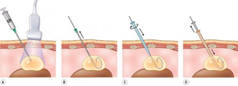 Quy trình diễn ra thủ thuật tiêm cồn nang thận