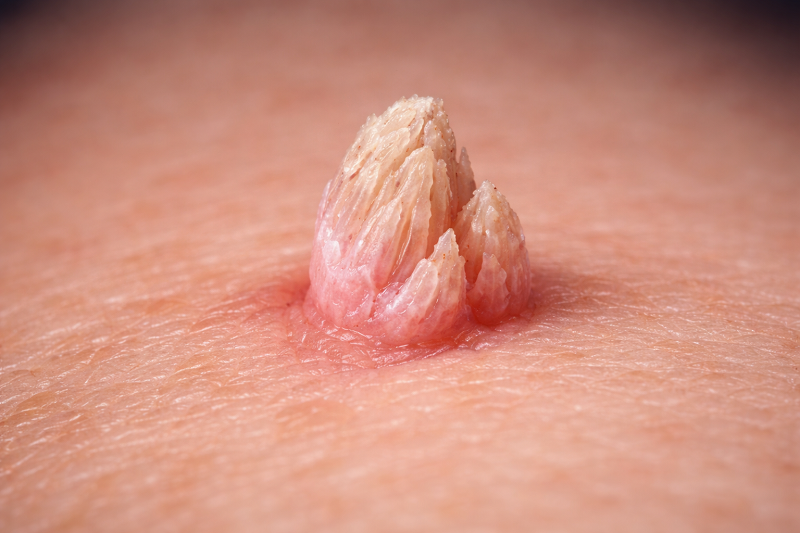 Sùi mào gà do virus HPV (Human Papillomavirus) gây ra.