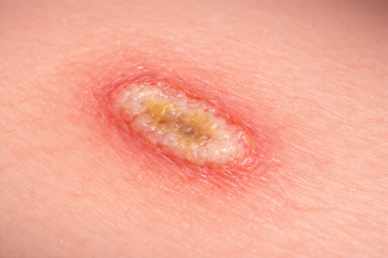 Các dấu hiệu như sưng đau, chảy mủ hoặc sốt sau đốt sùi mào gà cần được thăm khám sớm.