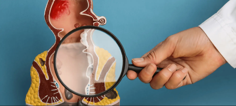 Các phương pháp điều trị bệnh trĩ được áp dụng cho từng mức độ cụ thể 