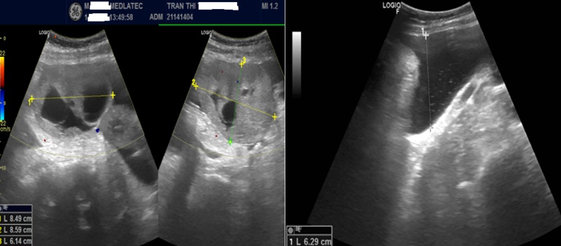Hình ảnh siêu âm ổ bụng của bệnh nhân 