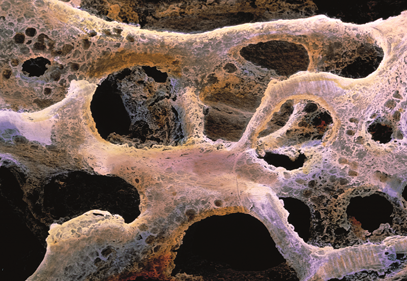 Loãng xương ở phụ nữ tiền mãn kinh là tình trạng nhiều chị em gặp phải. Ảnh minh họa 