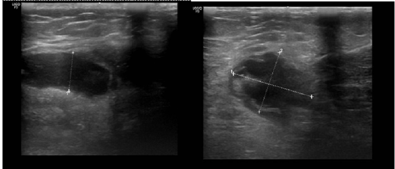 Hình ảnh tràn dịch khớp gối trái ghi nhận trên siêu âm