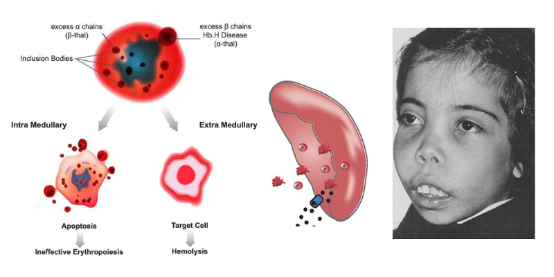 Thalassemia gây ra biến đổi trên cả tế bào máu và gương mặt người bệnh. Ảnh minh họa 