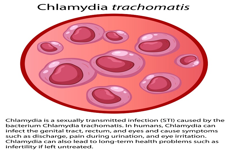Chlamydia trachomatis gây bệnh lây truyền đường tình dục thường khiến nữ giới bị ra khí hư bất thường 