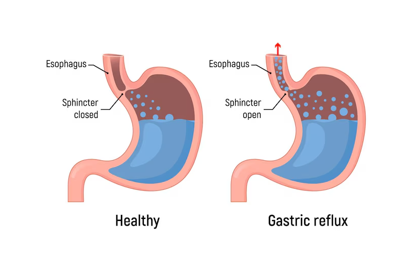 Trào ngược dạ dày – thực quản thường gây nôn ở trẻ sơ sinh và trẻ nhỏ sau ăn.