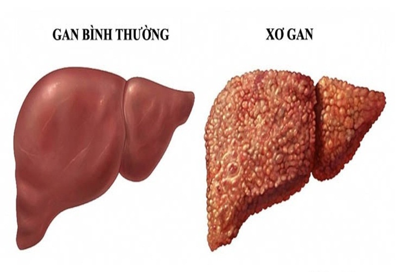 Tìm hiểu về hiện tượng xơ gan 