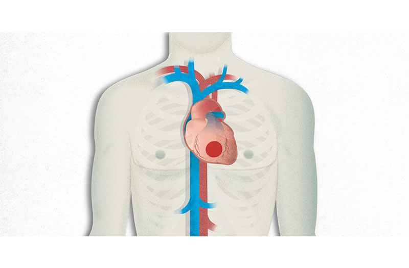 Khi nào cần thực hiện ECG để kiểm tra tình trạng thiếu máu cơ tim?
