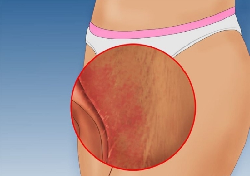 Chàm da ở nữ có thể xảy ra do nhiều nguyên nhân khác nhau