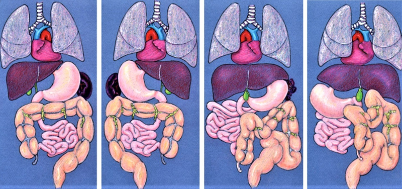 Đảo ngược phủ tạng là một dị tật hiếm gặp, với tỷ lệ mắc bệnh ước tính trong khoảng 1:10.000 đến 1:20.000 dân số. Ảnh minh họa