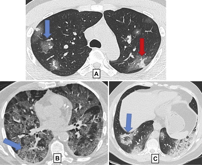 Những dấu hiệu tổn thương phổi do Covid qua chụp CT