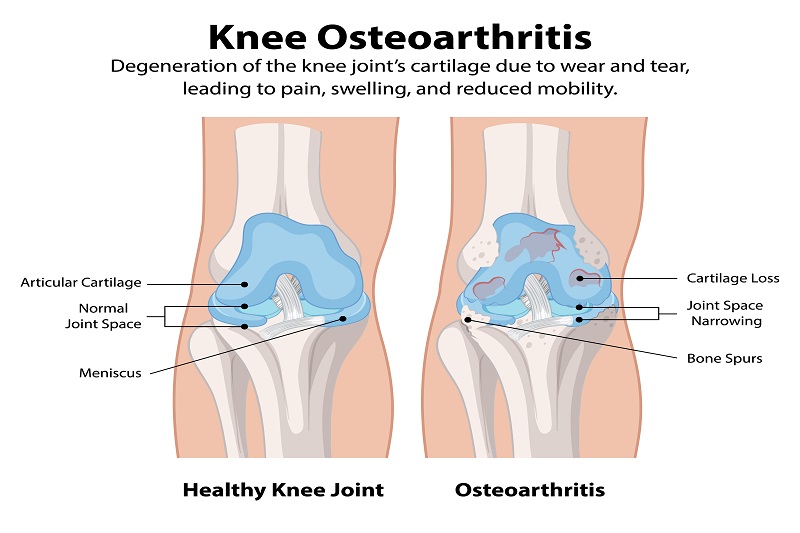 Nếu bị thoái hóa khớp gối nặng tốt nhất bạn không nên nhảy dây