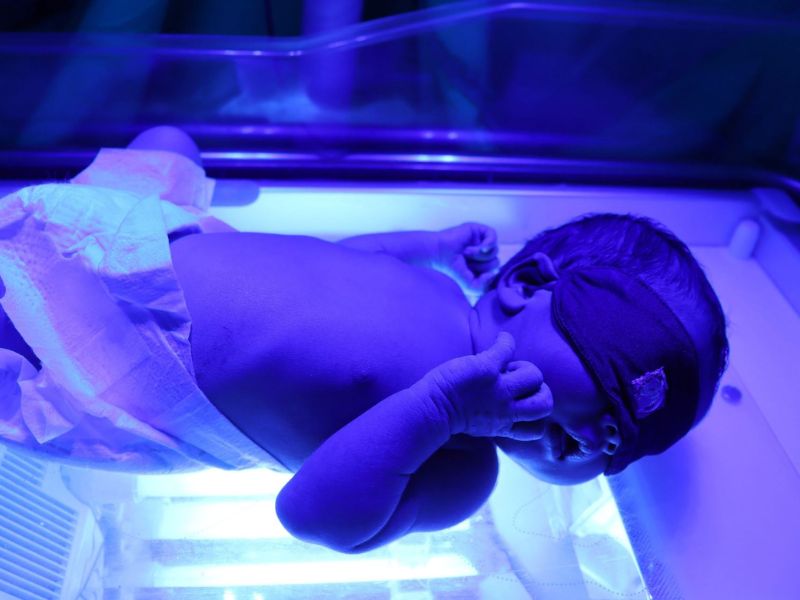 Trẻ sinh non dễ có nguy cơ bị vàng da 