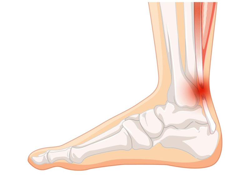 Đứt gân gót chân - một dạng chấn thương nghiêm trọng cần được chú ý