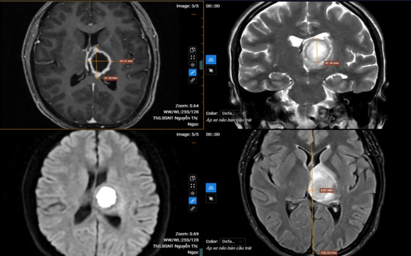 Kết quả MRI phát hiện tổn thương khu trú tại vùng đồi thị – vành tia bên trái 