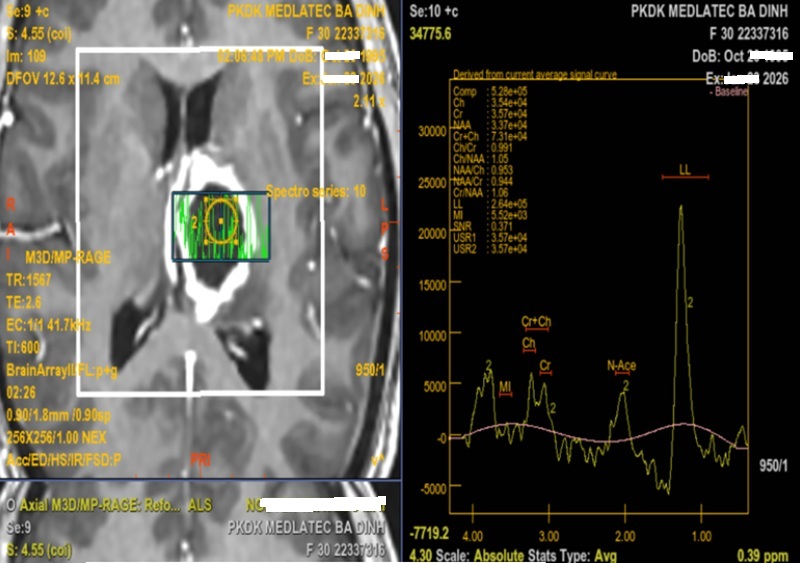 Kết quả chụp cộng hưởng từ phổ của bệnh nhân 