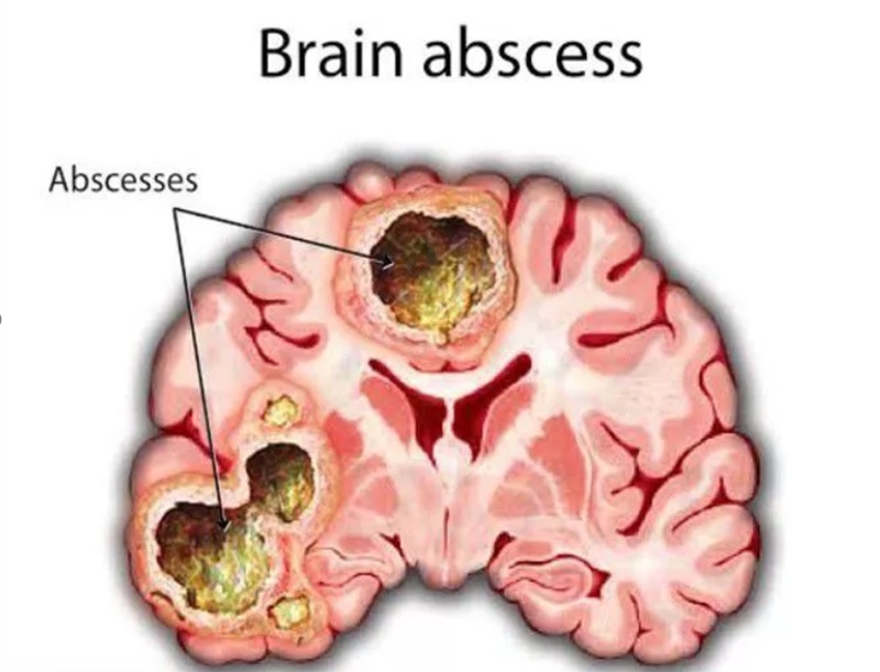 Áp xe não là tình trạng viêm nhiễm khu trú trong nhu mô não. Ảnh minh họa 
